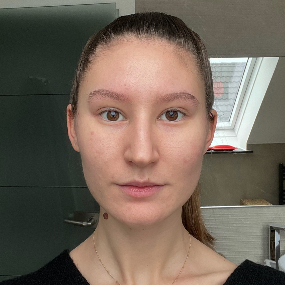 Lara Resultate Balanced Skin Ekzem irritierte Haut pickel after